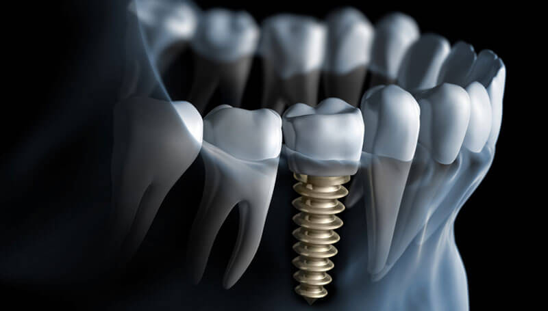 What happens in a dental implant procedure